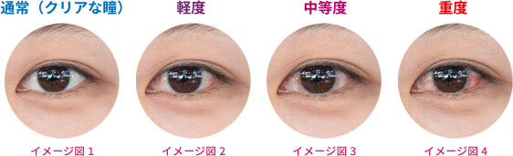 充血レベル一覧