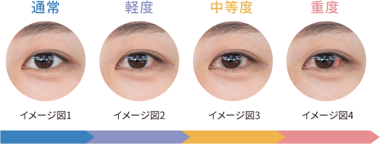 ところで、どこからが充血？