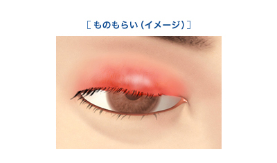 麦粒腫 ものもらい ばくりゅうしゅ ものもらい 目の病気 症状 Eyeノート 一般生活者 患者のみなさま 千寿製薬株式会社