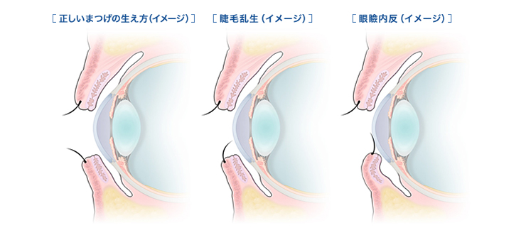 逆まつげ さかまつげ 目の病気 症状 Eyeノート 一般生活者 患者のみなさま 千寿製薬株式会社